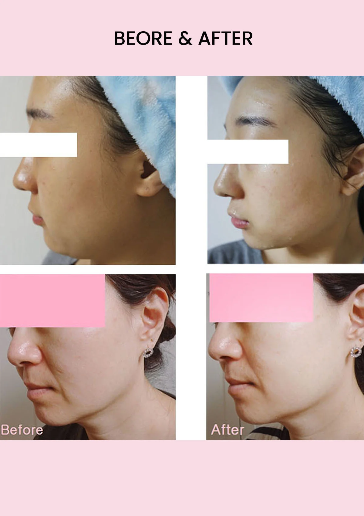 [PAMSIBC] Skinalle No Gravity Lifting Mask (1 Box  = 6 Masks) - Image 20